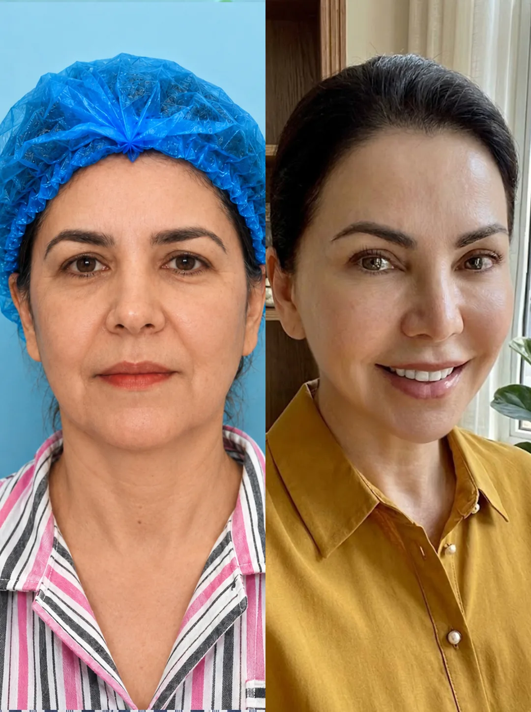 9D facial rejuvenation before and after example 1