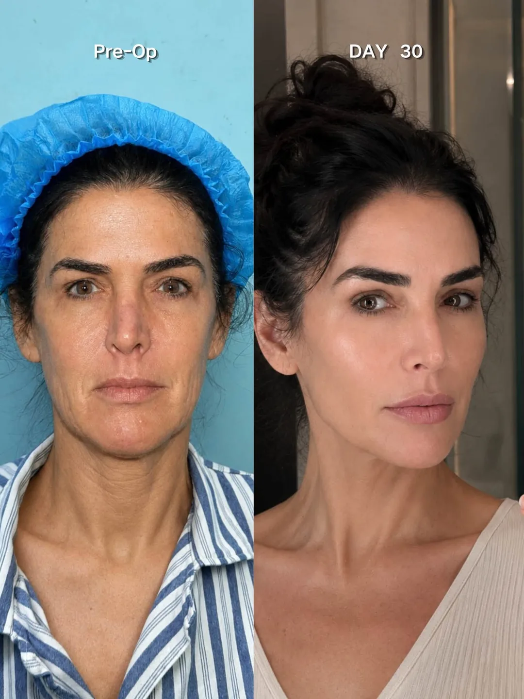 9D facial rejuvenation before and after example 3